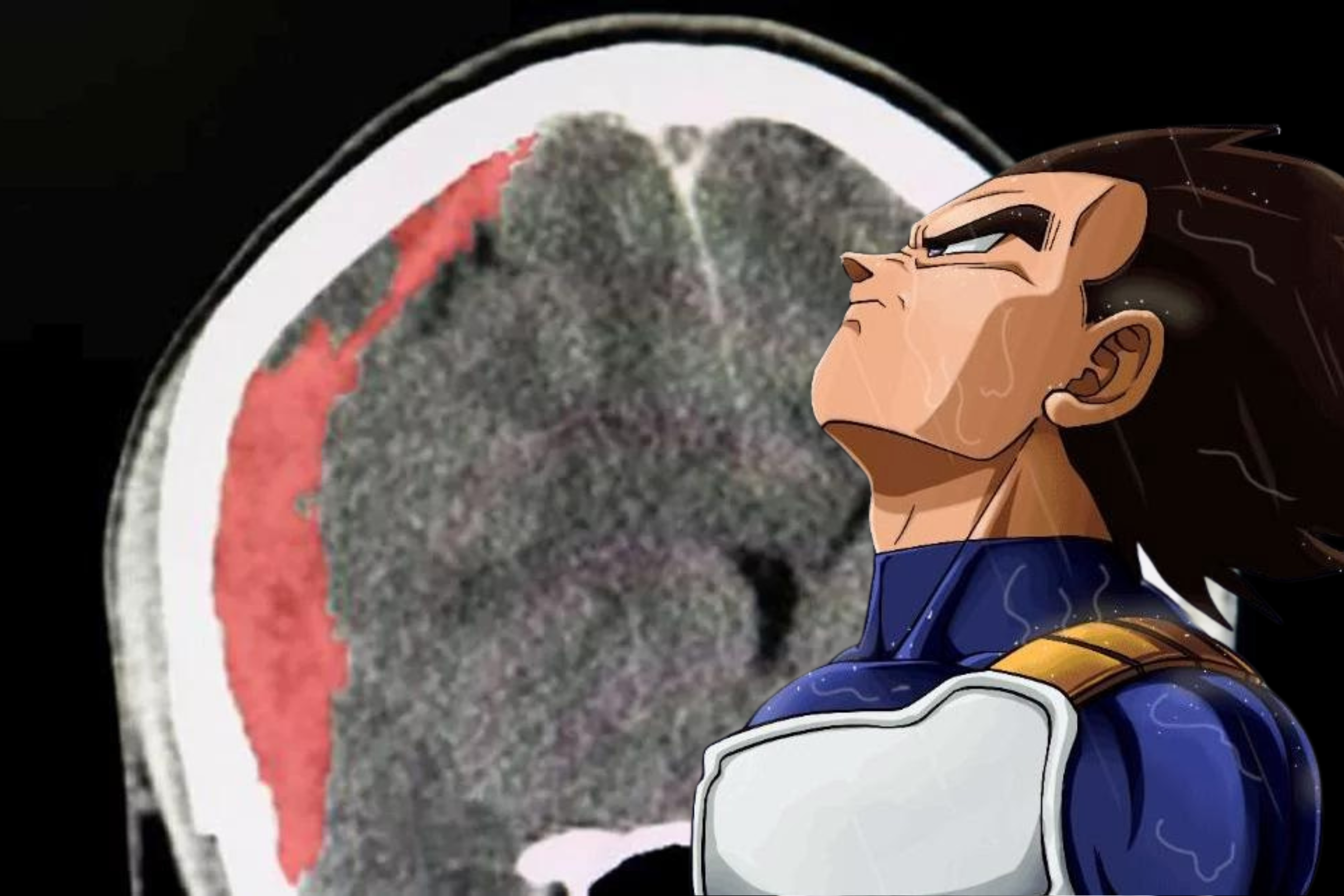 ¿Qué es el hematoma subdural, la causa de muerte de Akira Toriyama?