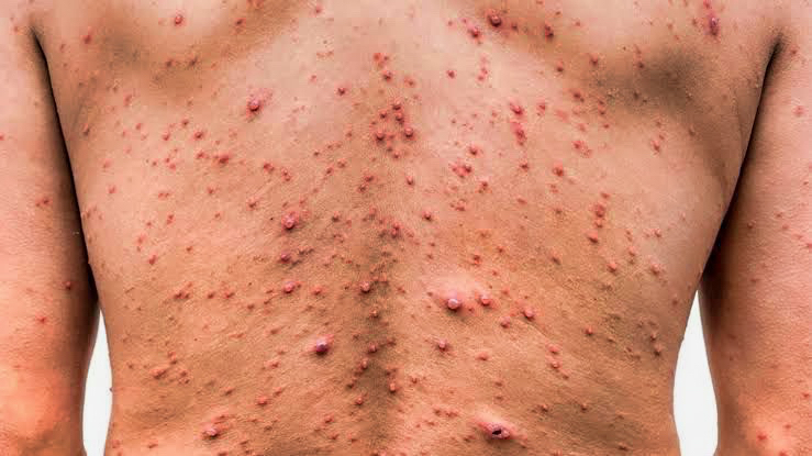 recomendaciones-salud-evitar-viruela-mono